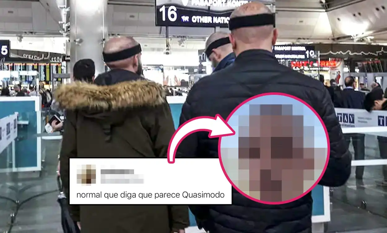 Un influencer se hace un injerto capilar y se le acaba «deformando» la cara  - CABROWORLD